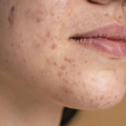 Acne