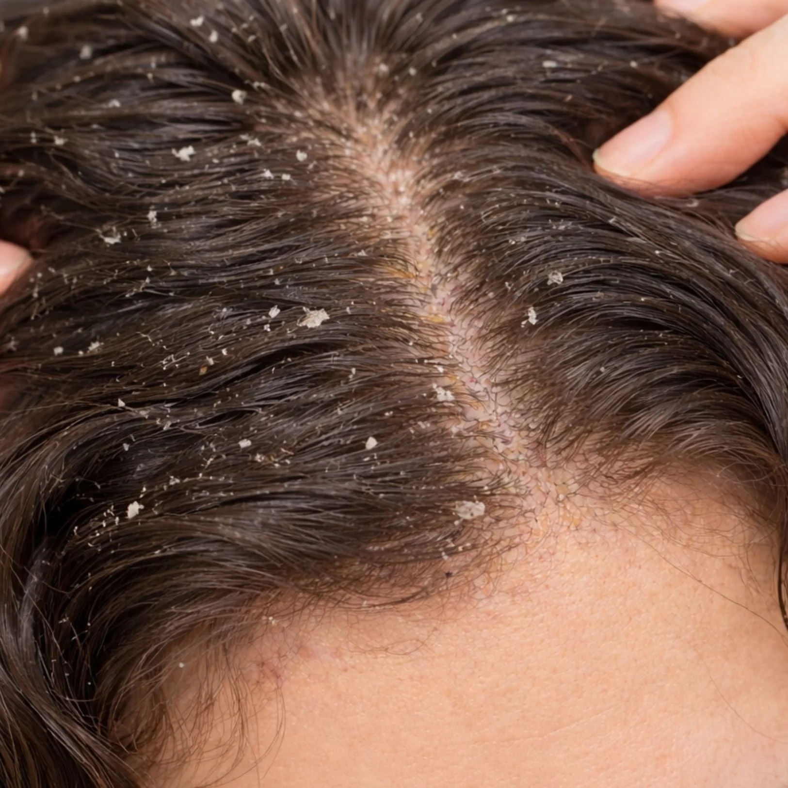 Dandruff