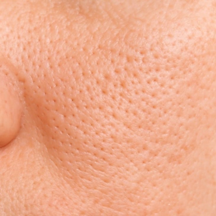 Large Pores/Texture