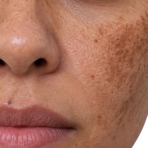 Body Pigmentation
